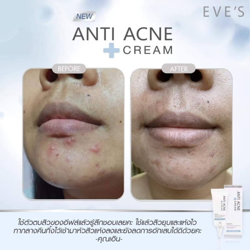 "EVE’S" EVE'S ANTI ACNE CREAM (9 g) - "อีฟส์" แอนตี้ แอคเน่ ครีม 