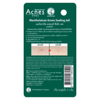"MENTHOLATUM" Acnes Sealing Jell Acne Treatment Gel  (5 grams) - แต้มสิว "MENTHOLATUM" Acnes Sealing Jell Acne Treatment Gel  (5 grams) - แต้มสิว